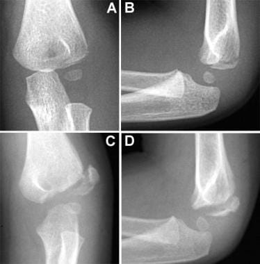 Lateral condyle fracture with instability. Initial