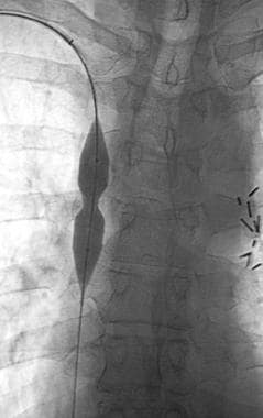 Superior vena cava syndrome (case 1, cont'd). A Pa