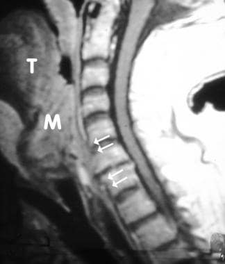 Sagittal T1-weighted image of a patient with laryn