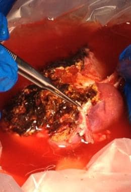 The left lobe graft in the preservation solution b