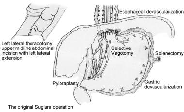 Sugiura procedure. 