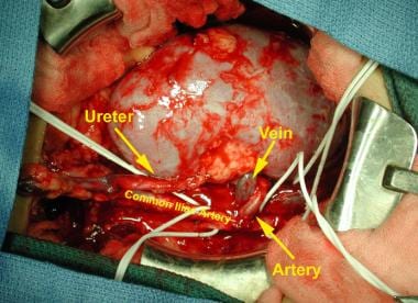 Vascular anastomoses used in a kidney transplantat