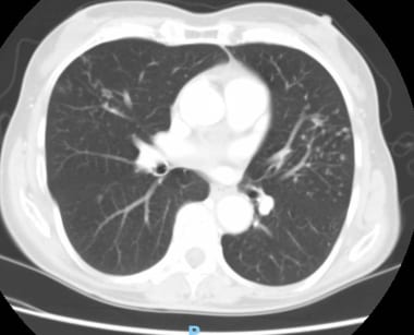Thoracic CT scan in a 72-year-old woman who presen