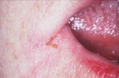 Angular cheilitis; a common form of oral candidias