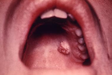 A 7-year retrospective study of biopsied oral lesions in 460