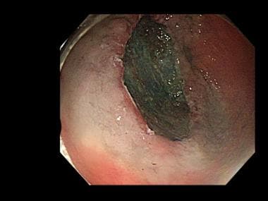 Endoscopic submucosal dissection (ESD). Completion