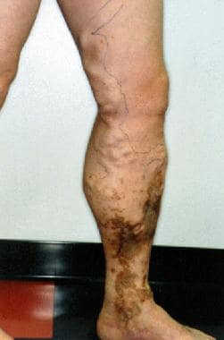 Chronic venous insufficiency from a dermatological perspective