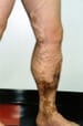 Venous Insufficiency