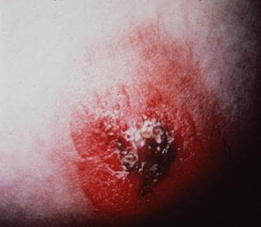 Thirty-three-year-old patient with left unilateral inverted nipple