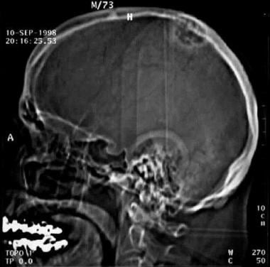 Lateral skull radiograph of a 73-year-old patient 