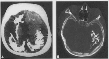 leptomeningeal angiomas