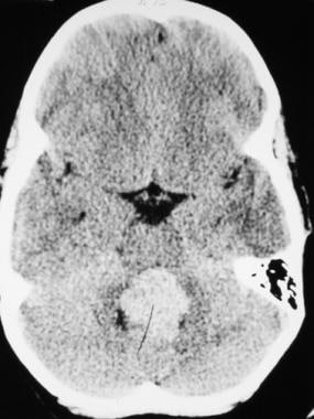 CT scan demonstrates a hyperdense lesion within th