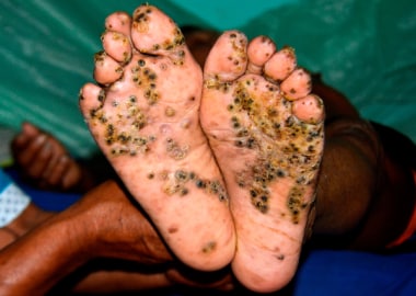 Image of Tungiasis infection on both feet. Courtes