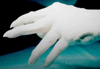 Typical appearance of the hand following rupture o