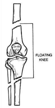 Floating knee injury. 
