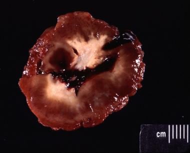Bisected gross specimen of giant cell tumor in pre
