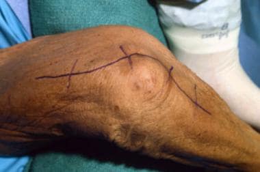 Incision is made along proximal 5 cm of medial uln