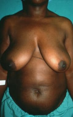 Patient 1. This patient has a large breast to matc