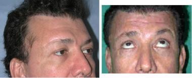 Direct brow lift. Injury to the temporal (frontal)