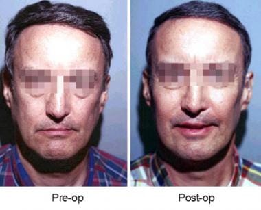 Frontal view of patient before and after insertion