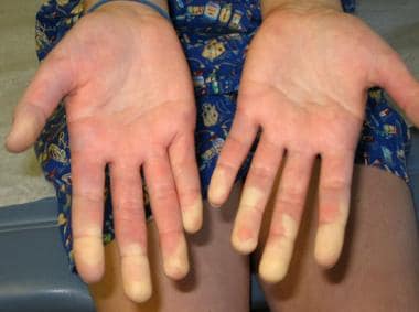 Raynaud Phenomenon Practice Essentials Pathophysiology Etiology