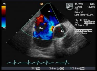 Transesophageal echocardiogram: Moderate-large ASD