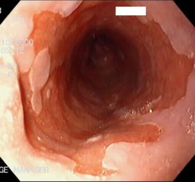 Barrett esophagus (BE). The salmon-pink area has s