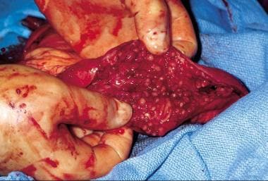 ulcerative colitis mucus in stool