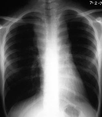 Posteroanterior (PA) chest radiograph in a man wit