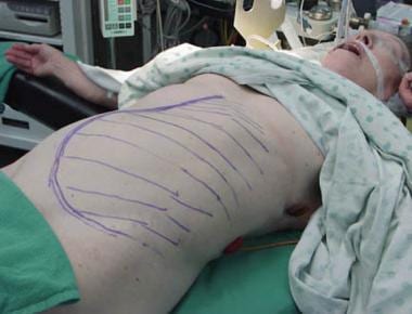 Preoperative photograph of the patient presenting a massive abdominal