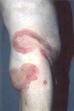 A), Well-circumscribed, painful, infiltrative erythema with tense