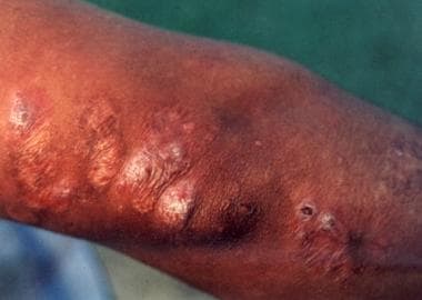 Healed cutaneous leishmaniasis lesions. Photo cour