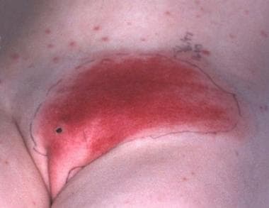 Pustules on the back possibly triggering toxic-shock syndrome