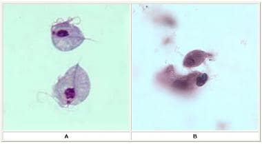 trichomonads and clue cells