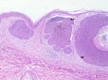 Nodular basal cell carcinoma. Nodular aggregates o