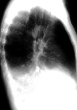 Atelectasis. Right lower lobe collapse. 