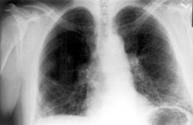 Chest radiograph of a patient with chronic hyperse