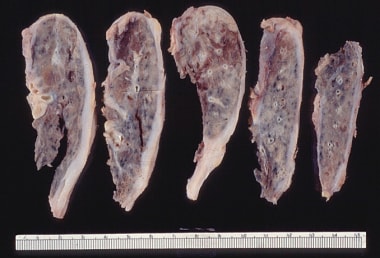 Restrictive Lung Disease: Background, Pathophysiology 