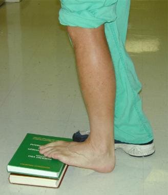 Haglunds/Heel Spur/Achilles Tendinitis - Christopher Miller