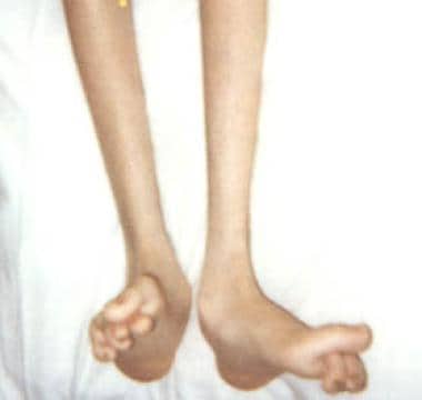 Foot deformities in a 16-year-old boy with Charcot