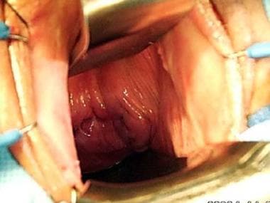 Vesicovaginal and Ureterovaginal Fistula Clinical Presentation