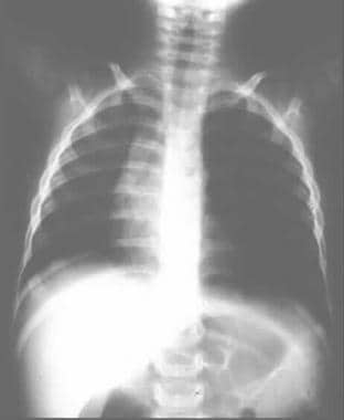 一名已知上呼吸道感染的患者的胸片