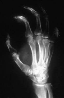 Osteomyelitis of index finger metacarpal head seco