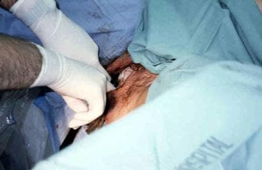 Assisted vaginal breech delivery. Thick meconium p