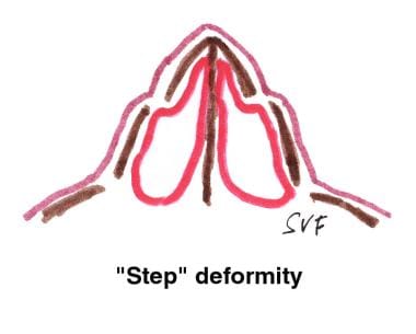 Diagrammatic representation of the "step" deformit