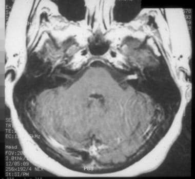 5th of facial nerve mri