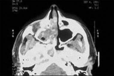 Axial CT scan of sinuses shows a right fungal maxi