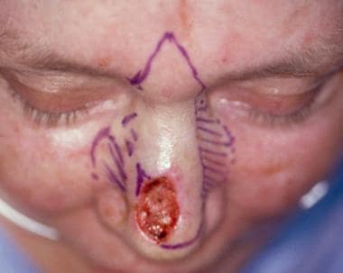 The dorsal nasal rotation flap places incisions al