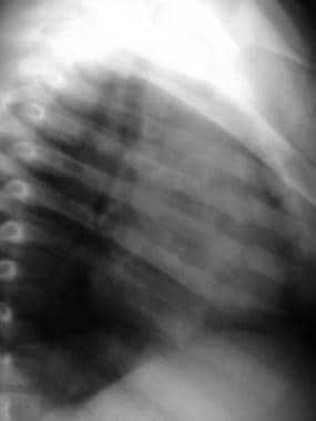 Radiograph of multiple rib fractures. Radiographs 