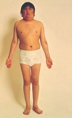 A 16-year-old boy with Cushing disease. 